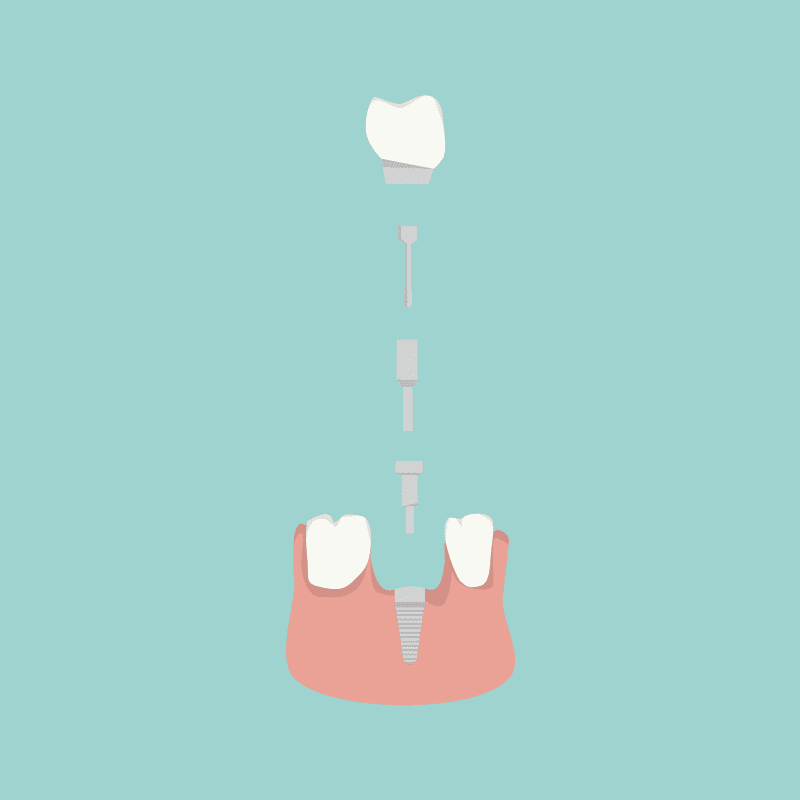 Aufbau eines Zahnimplantats
