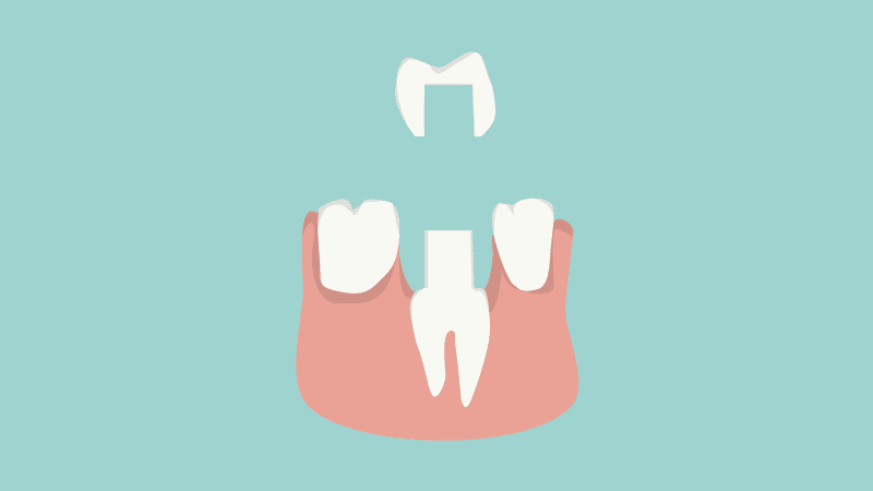 Aufbau einer Zahnkrone